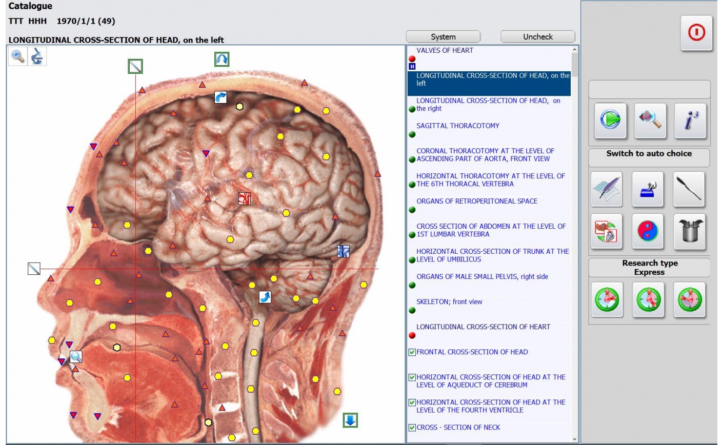 The Development Of NLS-diagnostics With Metatron 4025 Hunter For Major Duodenal Papilla Tumors