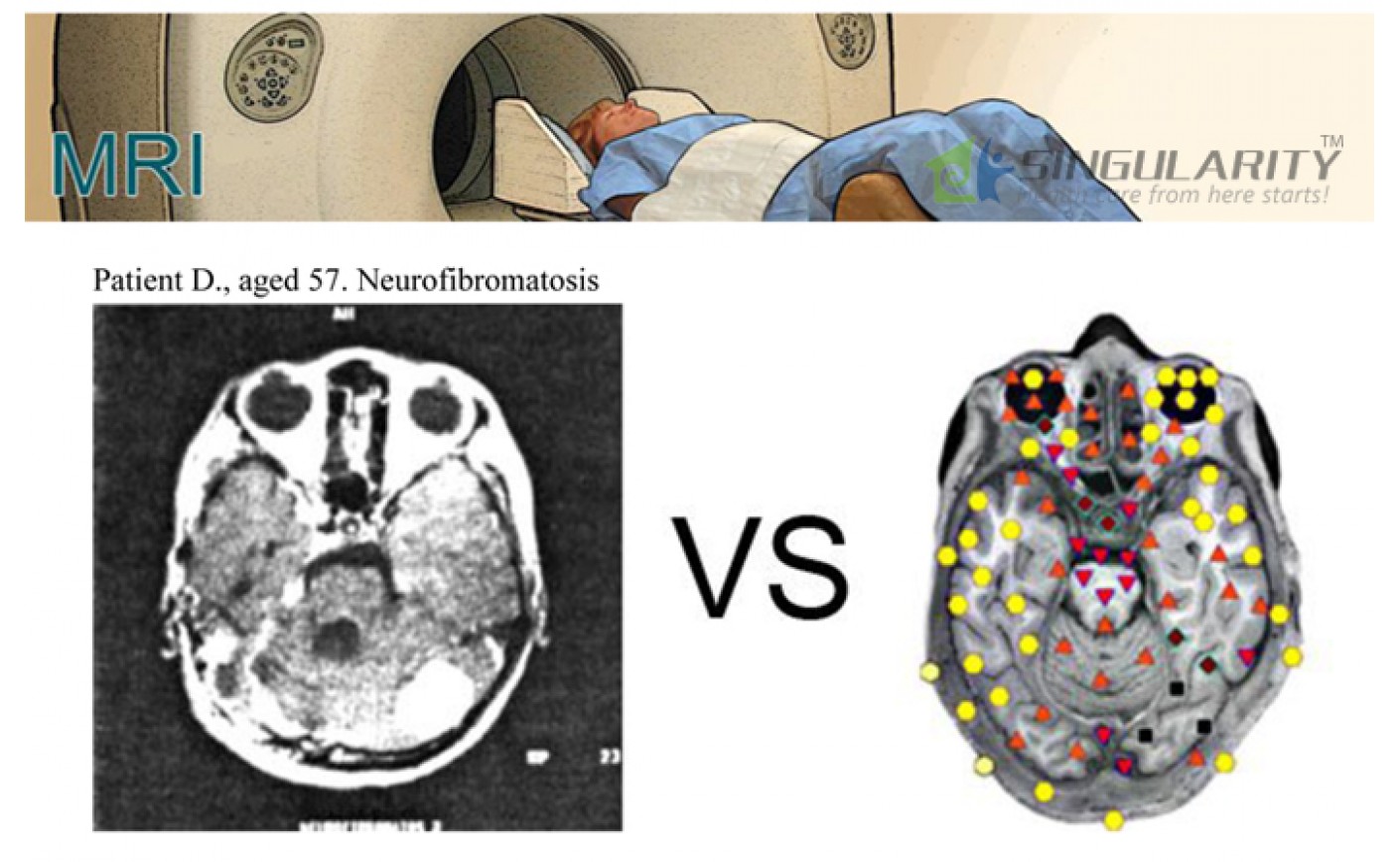 Both MRI and NLS-research Of Hunter 4025 Scanner Have High Information Value In Diagnosis Tumors Of Soft Tissues